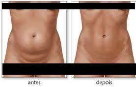 abdominoplastia-cicatriz