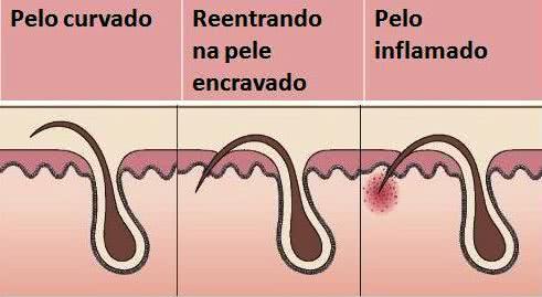 como-remover-pelos-encravados